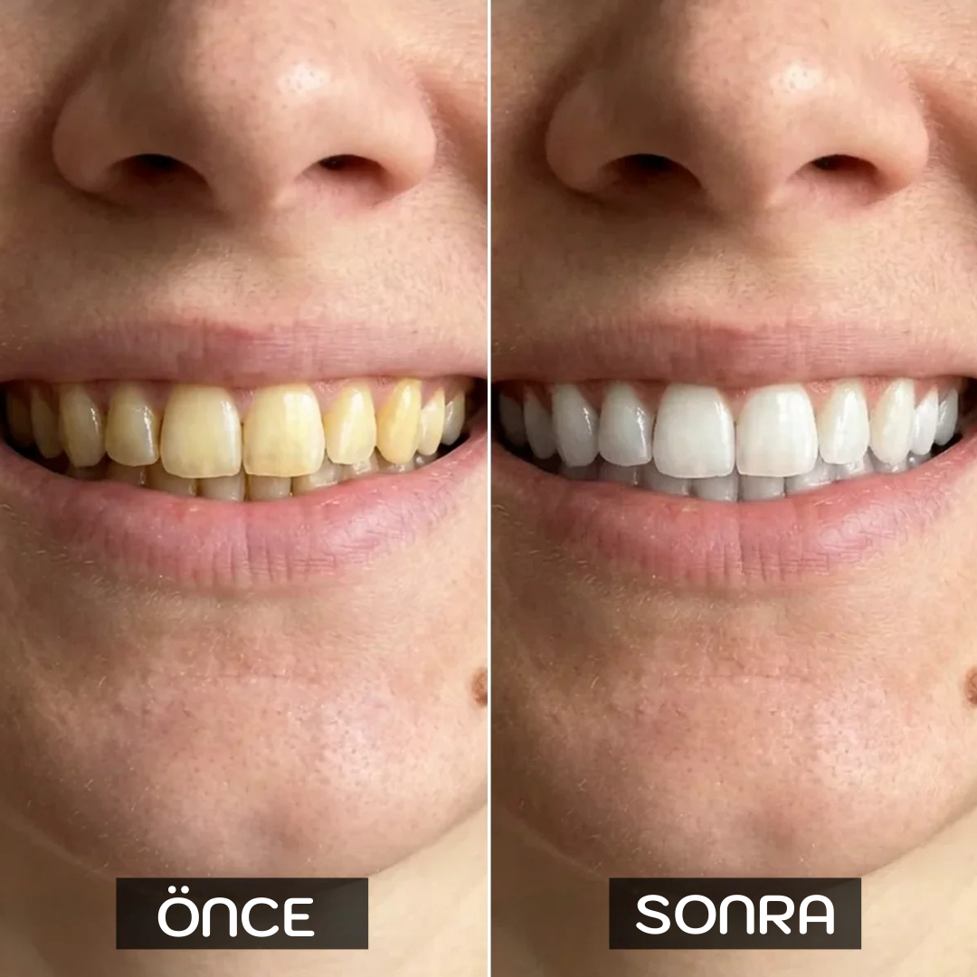 SMILENZA 16 LED’li Evde Diş Beyazlatma Kiti
