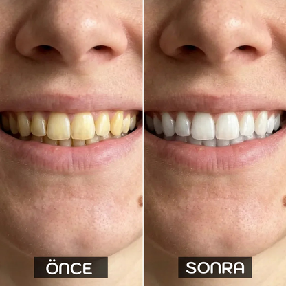 SMILENZA 16 LED’li Evde Diş Beyazlatma Kiti