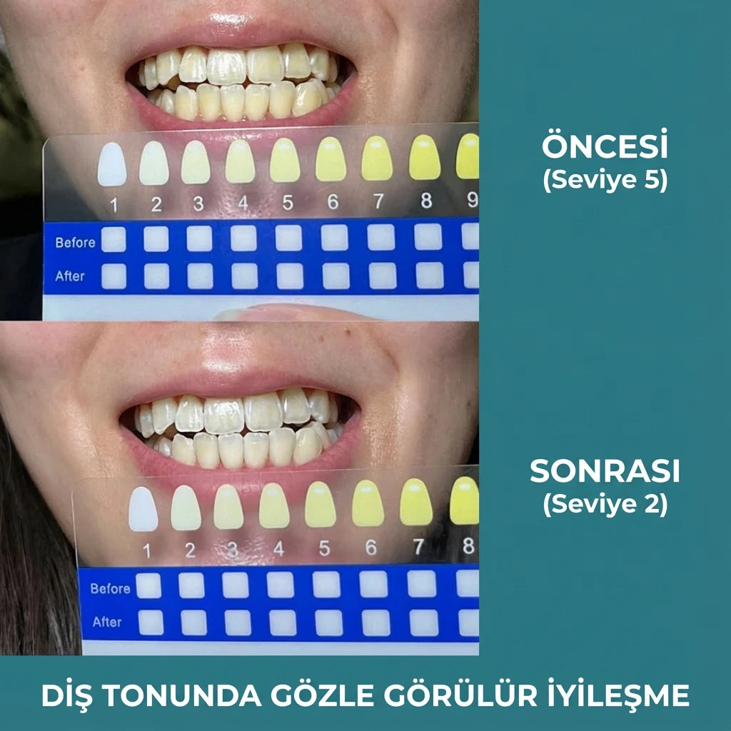 SMILENZA 16 LED’li Evde Diş Beyazlatma Kiti